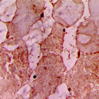 TNNI3K / CARK Antibody - Immunohistochemical analysis of CARK staining in human heart formalin fixed paraffin embedded tissue section. The section was pre-treated using heat mediated antigen retrieval with sodium citrate buffer (pH 6.0). The section was then incubated with the antibody at room temperature and detected using an HRP-conjugated compact polymer system. DAB was used as the chromogen. The section was then counterstained with hematoxylin and mounted with DPX.