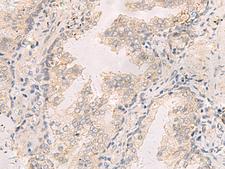 TNNT1 / TNT Antibody - Immunohistochemistry of paraffin-embedded Human prost at e cancer tissue  using TNNT1 Polyclonal Antibody at dilution of 1:35(×200)