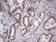 TNNT2 / CTNT Antibody - Immunohistochemical staining of paraffin-embedded Carcinoma of Human lung tissue using anti-TNNT2 mouse monoclonal antibody. (Heat-induced epitope retrieval by 1 mM EDTA in 10mM Tris, pH8.5, 120C for 3min,