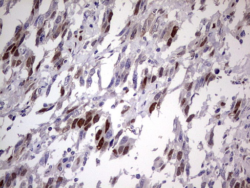 TNNT2 / CTNT Antibody - Immunohistochemical staining of paraffin-embedded Adenocarcinoma of Human ovary tissue using anti-TNNT2 mouse monoclonal antibody. (Heat-induced epitope retrieval by 1 mM EDTA in 10mM Tris, pH8.5, 120C for 3min,