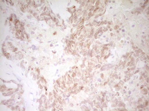 TNNT2 / CTNT Antibody - Immunohistochemical staining of paraffin-embedded Human adult heart tissue using anti-TNNT2 mouse monoclonal antibody. (Heat-induced epitope retrieval by 1 mM EDTA in 10mM Tris, pH8.5, 120C for 3min,