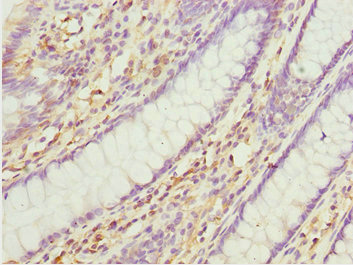 TNRC5 / CNPY3 Antibody - Immunohistochemistry of paraffin-embedded human colon cancer at dilution 1:100