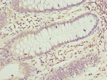 TNRC5 / CNPY3 Antibody - Immunohistochemistry of paraffin-embedded human colon cancer at dilution 1:100