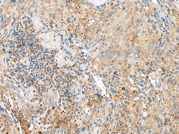 TNRC5 / CNPY3 Antibody - Immunohistochemistry of paraffin-embedded Human cervical cancer tissue  using CNPY3 Polyclonal Antibody at dilution of 1:55(×200)