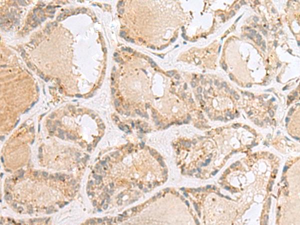 TNRC5 / CNPY3 Antibody - Immunohistochemistry of paraffin-embedded Human thyroid cancer tissue  using CNPY3 Polyclonal Antibody at dilution of 1:55(×200)