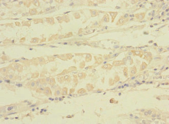 TNRC6A / GW182 Antibody - Immunohistochemistry of paraffin-embedded human gastric cancer using TNRC6A Antibody at dilution of 1:100