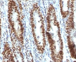 TNRC9 / TOX3 Antibody - Formalin-fixed, paraffin-embedded human gastric carcinoma stained with TOX3 antibody (TOX3/1123).  This image was taken for the unmodified form of this product. Other forms have not been tested.