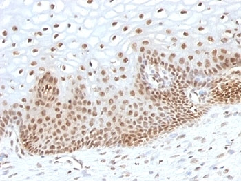 TNRC9 / TOX3 Antibody - Formalin-fixed, paraffin-embedded human cervical carcinoma stained with TOX3 antibody (TOX3/1123).  This image was taken for the unmodified form of this product. Other forms have not been tested.