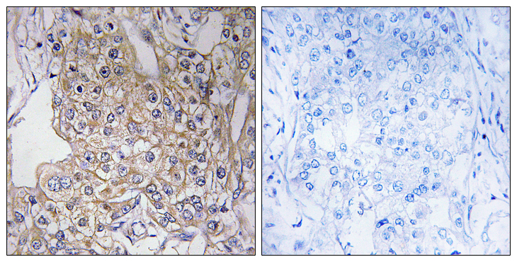 TNXB / Tenascin XB Antibody - Immunohistochemistry analysis of paraffin-embedded human breast carcinoma tissue, using TNXB Antibody. The picture on the right is blocked with the synthesized peptide.