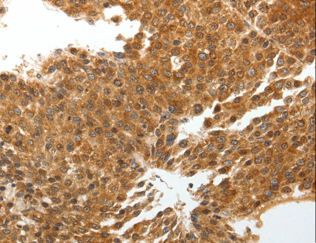 TNXB / Tenascin XB Antibody - Immunohistochemistry of paraffin-embedded Human liver cancer using TNXB Polyclonal Antibody at dilution of 1:40.