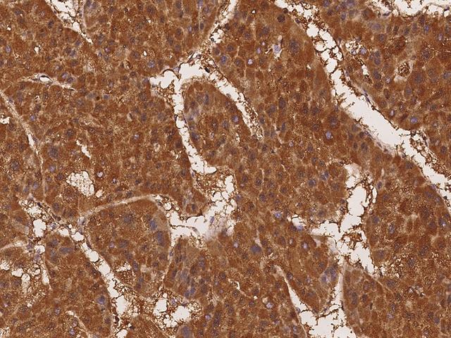 TNXB / Tenascin XB Antibody - Immunochemical staining of human TNXB in human hepatoma with rabbit polyclonal antibody at 1:100 dilution, formalin-fixed paraffin embedded sections.