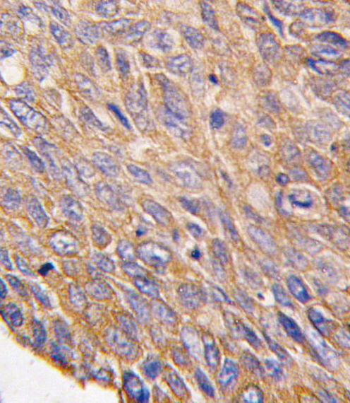 TOB2 Antibody - Formalin-fixed and paraffin-embedded human lung carcinoma tissue reacted with TOB2 antibody , which was peroxidase-conjugated to the secondary antibody, followed by DAB staining. This data demonstrates the use of this antibody for immunohistochemistry; clinical relevance has not been evaluated.