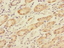 TOB2 Antibody - Immunohistochemistry of paraffin-embedded human gastric cancer at dilution 1:100