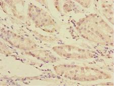 TOB2 Antibody - Immunohistochemistry of paraffin-embedded human gastric cancer at dilution 1:100