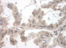 TOCA1 / FNBP1L Antibody - Detection of Human Toca-1 by Immunohistochemistry. Sample: FFPE section of human lung carcinoma. Antibody: Affinity purified rabbit anti-Toca-1 used at a dilution of 1:1000 (1 ug/mg).