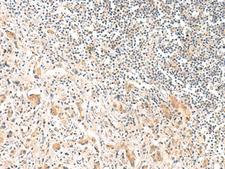 TOCA1 / FNBP1L Antibody - Immunohistochemistry of paraffin-embedded Human prost at e cancer tissue  using FNBP1L Polyclonal Antibody at dilution of 1:30(×200)