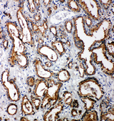 TOLLIP Antibody - TOLLIP antibody. IHC(P):Human Prostatic Cancer Tissue.