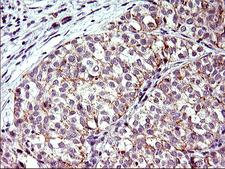 TOLLIP Antibody - IHC of paraffin-embedded Carcinoma of Human liver tissue using anti-TOLLIP mouse monoclonal antibody. (Heat-induced epitope retrieval by 10mM citric buffer, pH6.0, 120°C for 3min).