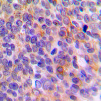 TOLLIP Antibody - Immunohistochemical analysis of TOLLIP staining in human breast cancer formalin fixed paraffin embedded tissue section. The section was pre-treated using heat mediated antigen retrieval with sodium citrate buffer (pH 6.0). The section was then incubated with the antibody at room temperature and detected using an HRP conjugated compact polymer system. DAB was used as the chromogen. The section was then counterstained with hematoxylin and mounted with DPX.