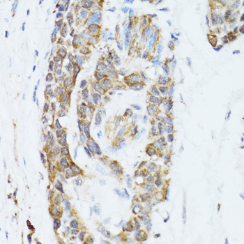 TOLLIP Antibody - Immunohistochemistry of paraffin-embedded mouse esophageal cancer tissue.