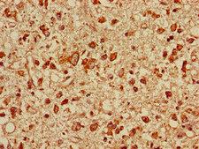 TOLLIP Antibody - Immunohistochemistry of paraffin-embedded human glioma cancer using TOLLIP Antibody at dilution of 1:100