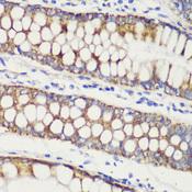 TOMM20 Antibody - Immunohistochemistry of paraffin-embedded Human colon carcinoma using TOM20 Polyclonal Antibody at dilution of 1:100 (40x lens).
