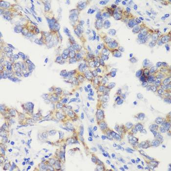 TOMM20 Antibody - Immunohistochemistry of paraffin-embedded Human lung cancer using TOM20 Polyclonal Antibody at dilution of 1:100 (40x lens).