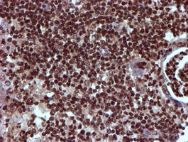 TOMM34 Antibody - IHC of paraffin-embedded Carcinoma of Human pancreas tissue using anti-TOMM34 mouse monoclonal antibody.