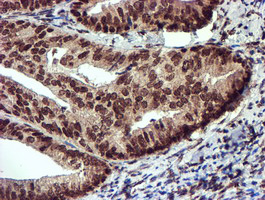 TOMM34 Antibody - IHC of paraffin-embedded Adenocarcinoma of Human endometrium tissue using anti-TOMM34 mouse monoclonal antibody.
