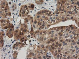 TOMM34 Antibody - IHC of paraffin-embedded Carcinoma of Human bladder tissue using anti-TOMM34 mouse monoclonal antibody.