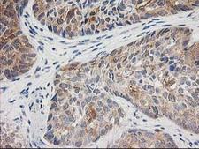TOMM34 Antibody - IHC of paraffin-embedded Adenocarcinoma of Human breast tissue using anti-TOMM34 mouse monoclonal antibody.