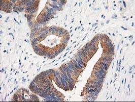 TOMM34 Antibody - IHC of paraffin-embedded Adenocarcinoma of Human colon tissue using anti-TOMM34 mouse monoclonal antibody.