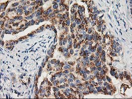 TOMM34 Antibody - IHC of paraffin-embedded Carcinoma of Human lung tissue using anti-TOMM34 mouse monoclonal antibody.