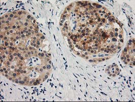 TOMM34 Antibody - IHC of paraffin-embedded Carcinoma of Human pancreas tissue using anti-TOMM34 mouse monoclonal antibody.