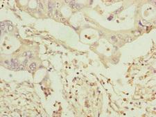TOMM34 Antibody - Immunohistochemistry of paraffin-embedded human pancreatic cancer at dilution of 1:100