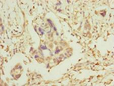 TOMM34 Antibody - Immunohistochemistry of paraffin-embedded human pancreatic cancer at dilution of 1:100