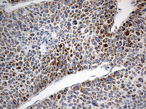 TOMM40 / TOM40 Antibody - Immunohistochemical staining of paraffin-embedded Carcinoma of Human liver tissue using anti-TOMM40 mouse monoclonal antibody. (Heat-induced epitope retrieval by 1mM EDTA in 10mM Tris buffer. (pH8.5) at 120°C for 3 min. (1:500)