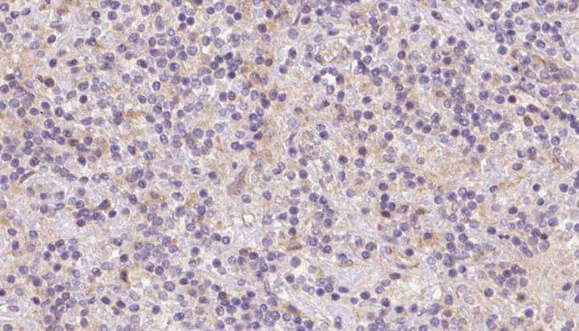 TOMM40 / TOM40 Antibody - 1:100 staining human lymph carcinoma tissue by IHC-P. The sample was formaldehyde fixed and a heat mediated antigen retrieval step in citrate buffer was performed. The sample was then blocked and incubated with the antibody for 1.5 hours at 22°C. An HRP conjugated goat anti-rabbit antibody was used as the secondary.