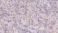 TOMM40 / TOM40 Antibody - 1:100 staining human lymph carcinoma tissue by IHC-P. The sample was formaldehyde fixed and a heat mediated antigen retrieval step in citrate buffer was performed. The sample was then blocked and incubated with the antibody for 1.5 hours at 22°C. An HRP conjugated goat anti-rabbit antibody was used as the secondary.