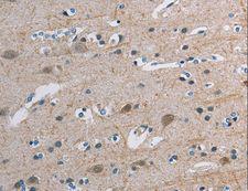 TONSL Antibody - Immunohistochemistry of paraffin-embedded Human breast cancer using TONSL Polyclonal Antibody at dilution of 1:45.