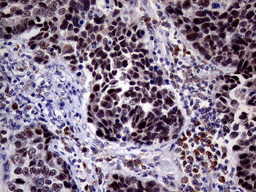 TOP1 / Topoisomerase I Antibody - Immunohistochemical staining of paraffin-embedded Carcinoma of Human lung tissue using anti-TOP1 mouse monoclonal antibody. (Heat-induced epitope retrieval by 1mM EDTA in 10mM Tris buffer. (pH8.5) at 120°C for 3 min. (1:500)