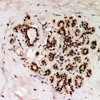 TOP1 / Topoisomerase I Antibody - IHC-P with human breast carcinoma