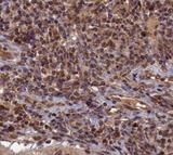 TOP1 / Topoisomerase I Antibody - Immunohistochemistry of paraffin-embedded human cervical cancer using TOP1 antibody at dilution of 1:50