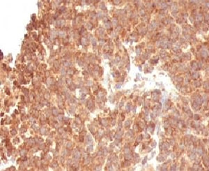 TOP1MT Antibody - Formalin-fixed, paraffin-embedded human melanoma stained with TOP1MT antibody (TOP1MT/488).  This image was taken for the unmodified form of this product. Other forms have not been tested.