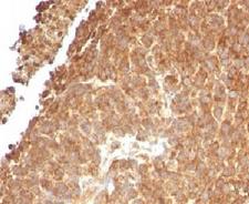 TOP1MT Antibody - IHC testing of FFPE human melanoma with TOP1MT antibody (clone TPIMT-1).  This image was taken for the unmodified form of this product. Other forms have not been tested.