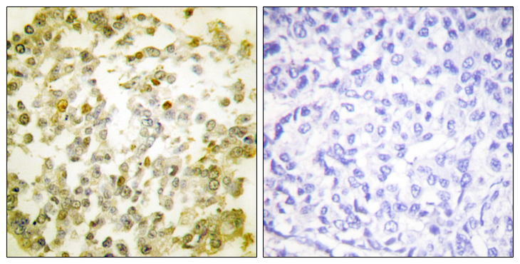 TOP2A / Topoisomerase II Alpha Antibody - Immunohistochemistry analysis of paraffin-embedded human breast carcinoma, using TOP2A Antibody. The picture on the right is blocked with the synthesized peptide.