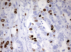 TOP2A / Topoisomerase II Alpha Antibody - IHC of paraffin-embedded Adenocarcinoma of Human colon tissue using anti-TOP2A mouse monoclonal antibody. (Heat-induced epitope retrieval by 10mM citric buffer, pH6.0, 120°C for 3min).