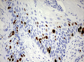 TOP2A / Topoisomerase II Alpha Antibody - IHC of paraffin-embedded Carcinoma of Human lung tissue using anti-TOP2A mouse monoclonal antibody. (Heat-induced epitope retrieval by 10mM citric buffer, pH6.0, 120°C for 3min).