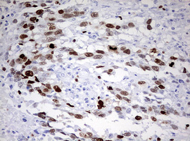 TOP2A / Topoisomerase II Alpha Antibody - IHC of paraffin-embedded Adenocarcinoma of Human ovary tissue using anti-TOP2A mouse monoclonal antibody. (Heat-induced epitope retrieval by 10mM citric buffer, pH6.0, 120°C for 3min).