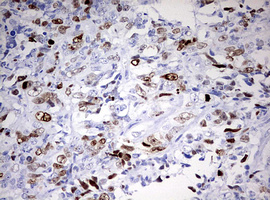 TOP2A / Topoisomerase II Alpha Antibody - IHC of paraffin-embedded Adenocarcinoma of Human endometrium tissue using anti-TOP2A mouse monoclonal antibody. (Heat-induced epitope retrieval by 10mM citric buffer, pH6.0, 120°C for 3min).
